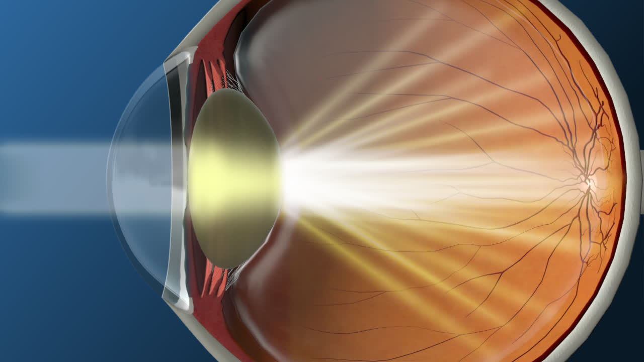 Read more about the article Use these tips to prepare for your cataract surgery