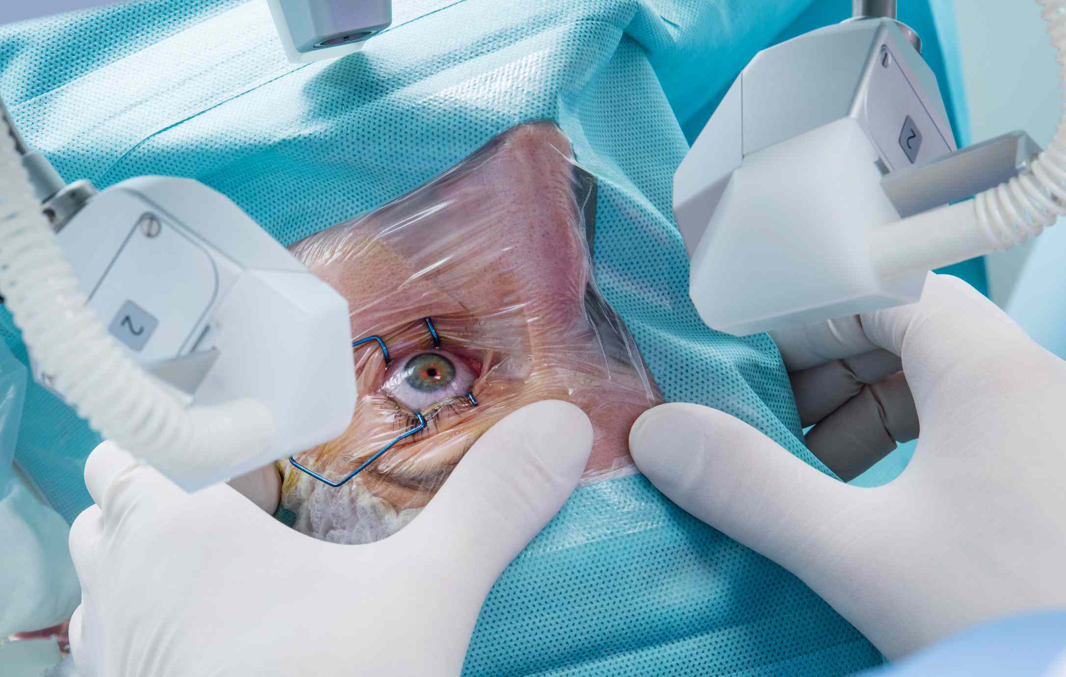 You are currently viewing What you probably didn’t know about cataract eye surgery